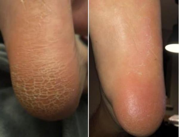 Anti-fungal Peeling Foot Soak photo review