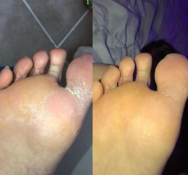 Anti-fungal Peeling Foot Soak photo review