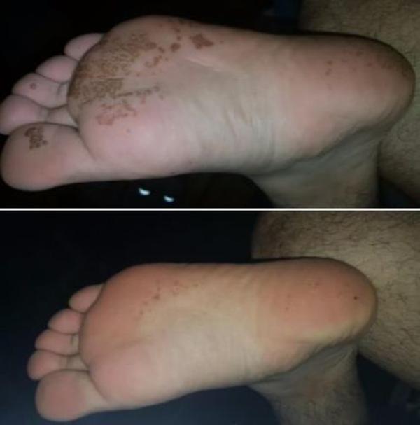 Anti-fungal Peeling Foot Soak photo review