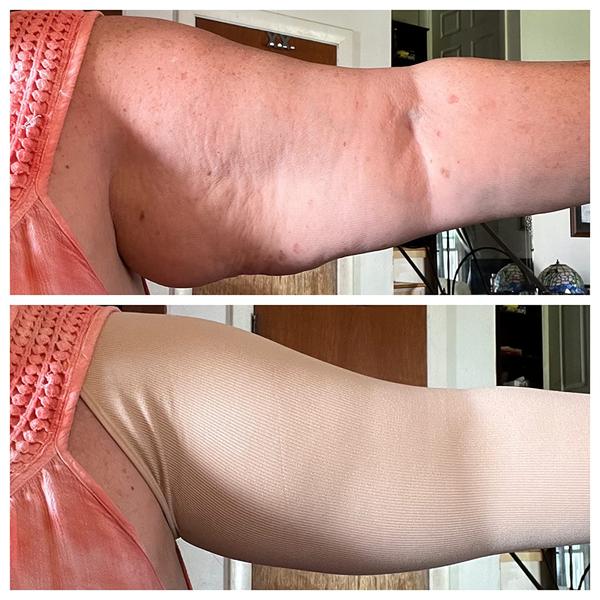 Arm Slimming Shaper - Slims Fat  and Improves Posture! photo review